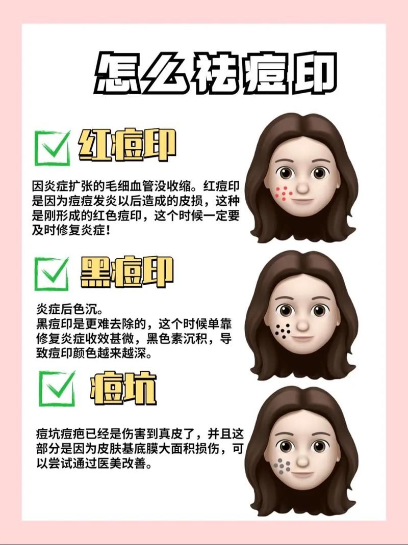点豆豆会留下痘印吗？了解这些避免脸上留疤！