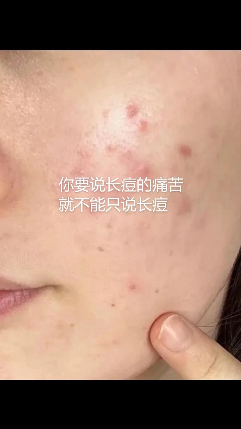 点豆豆会留下痘印吗？了解这些避免脸上留疤！