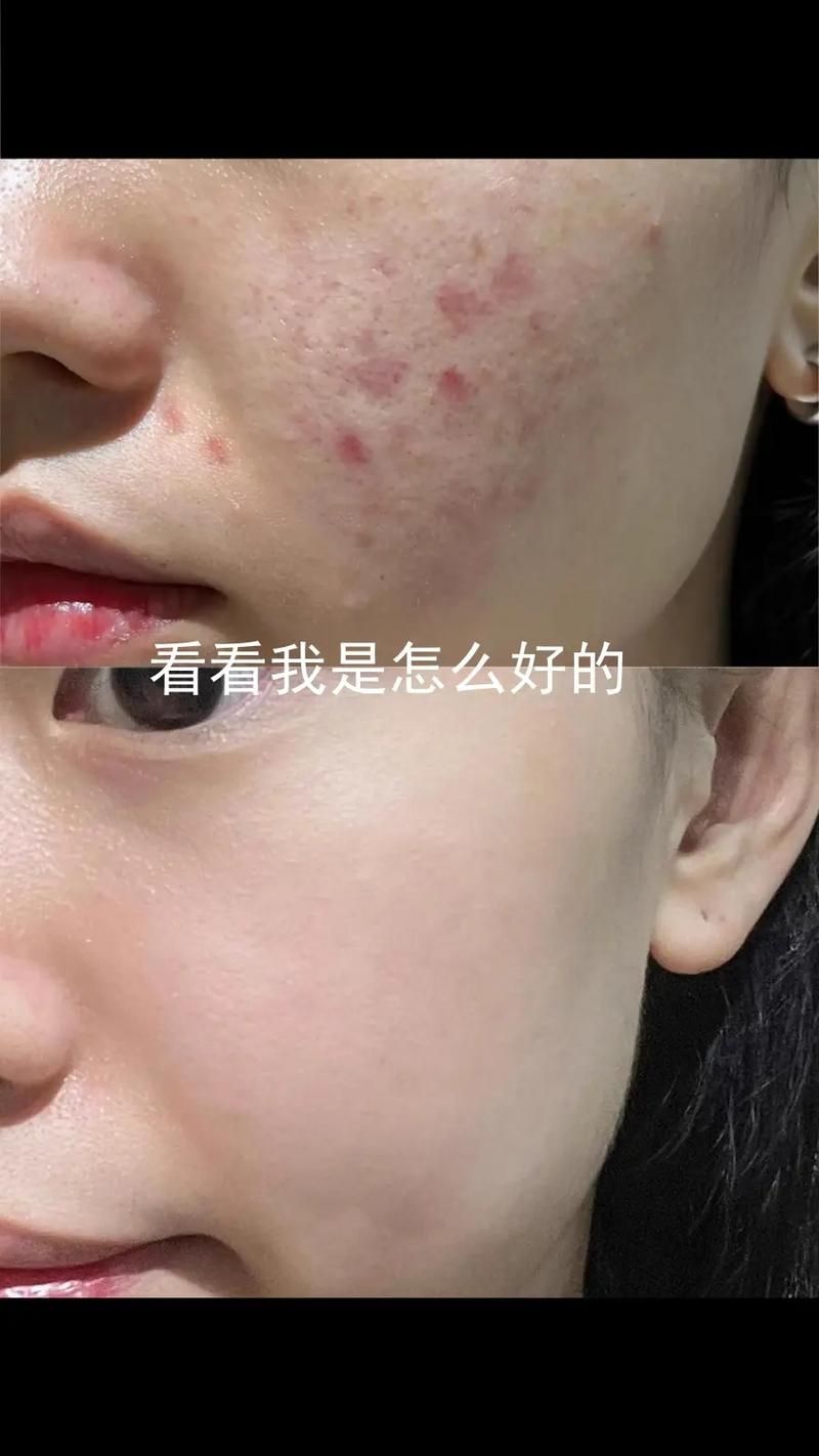 点豆豆会留下痘印吗？了解这些避免脸上留疤！