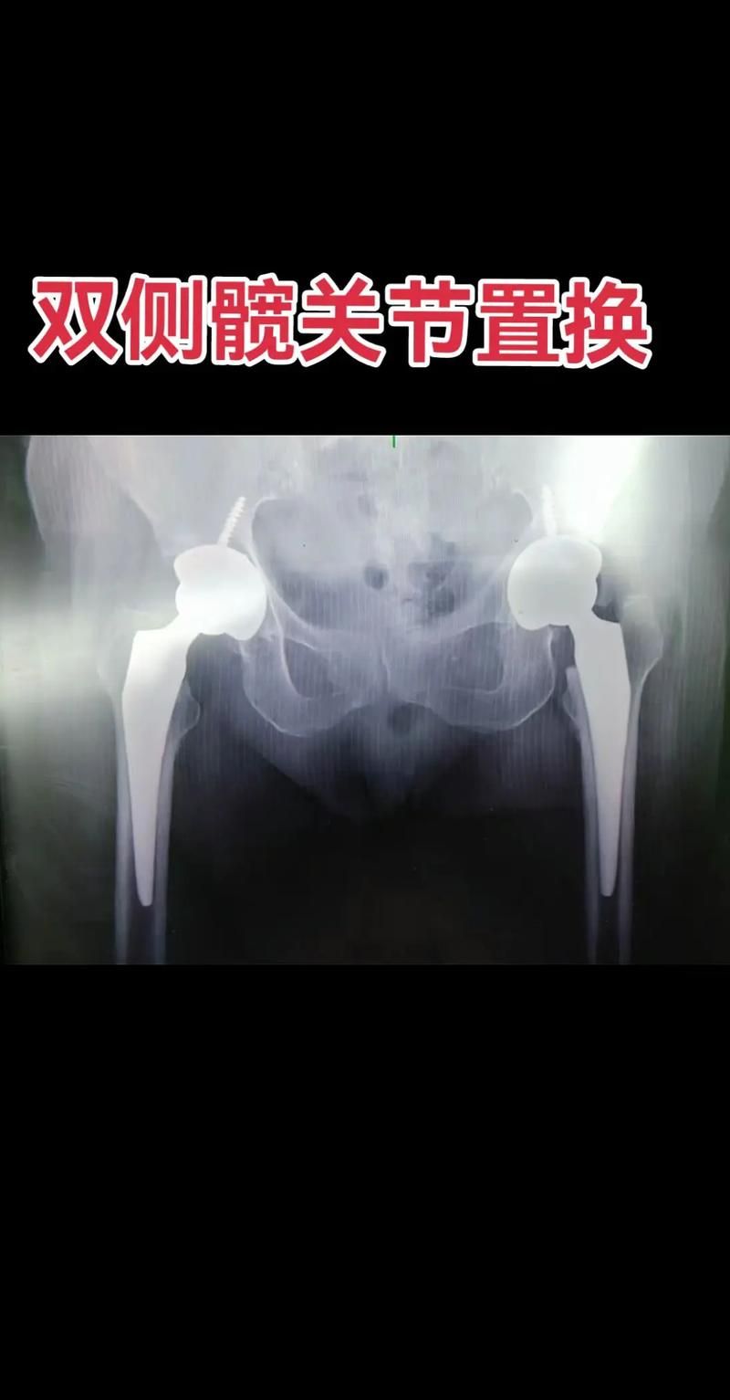 刘欢置换髋关节