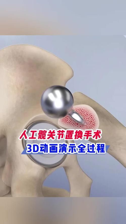 刘欢讲人工髋关节置换